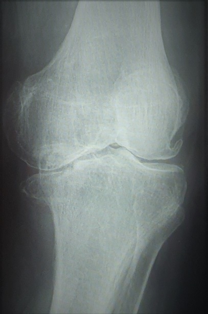 proteza jednoprzedziałowa kolana